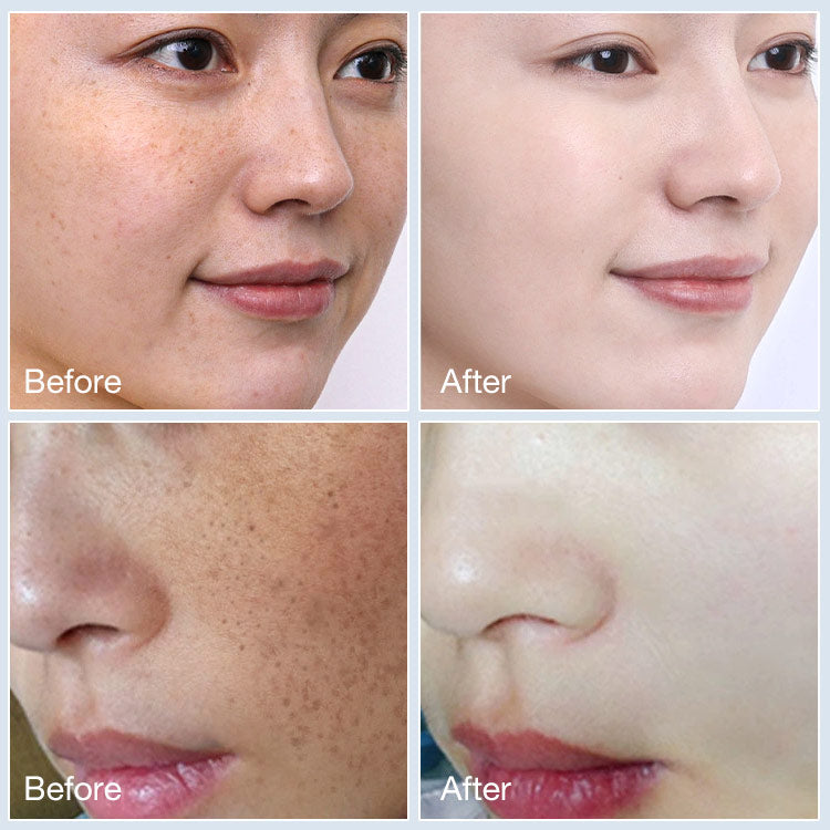 Tranexamic Acid Cream