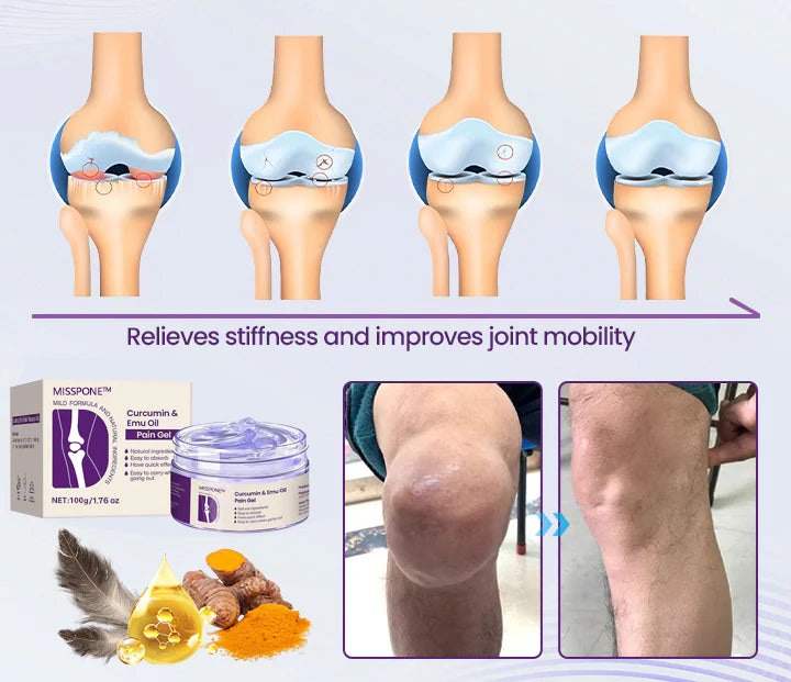 Misspone™ Curcumin & Emu Oil Pain Gel – 🏥Backed by US Osteopathic Experts