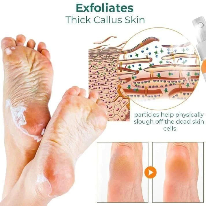 Foot Callus Removal Spray | Buy 1 + Get 1 Free