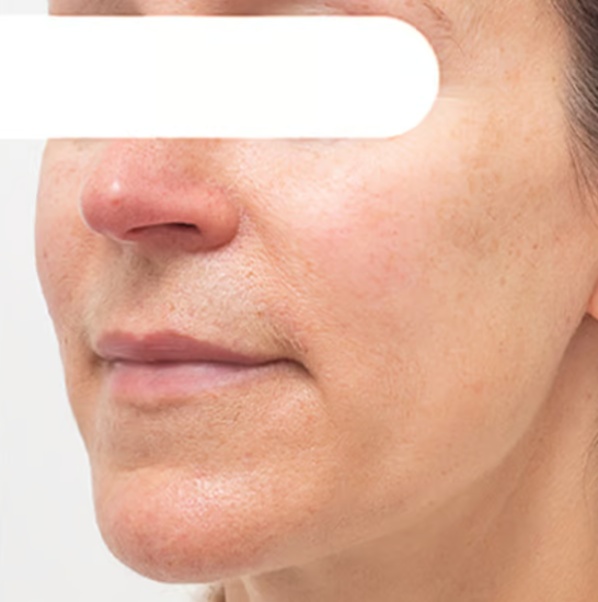 Herbal Spots Peel-Off Facial Mask