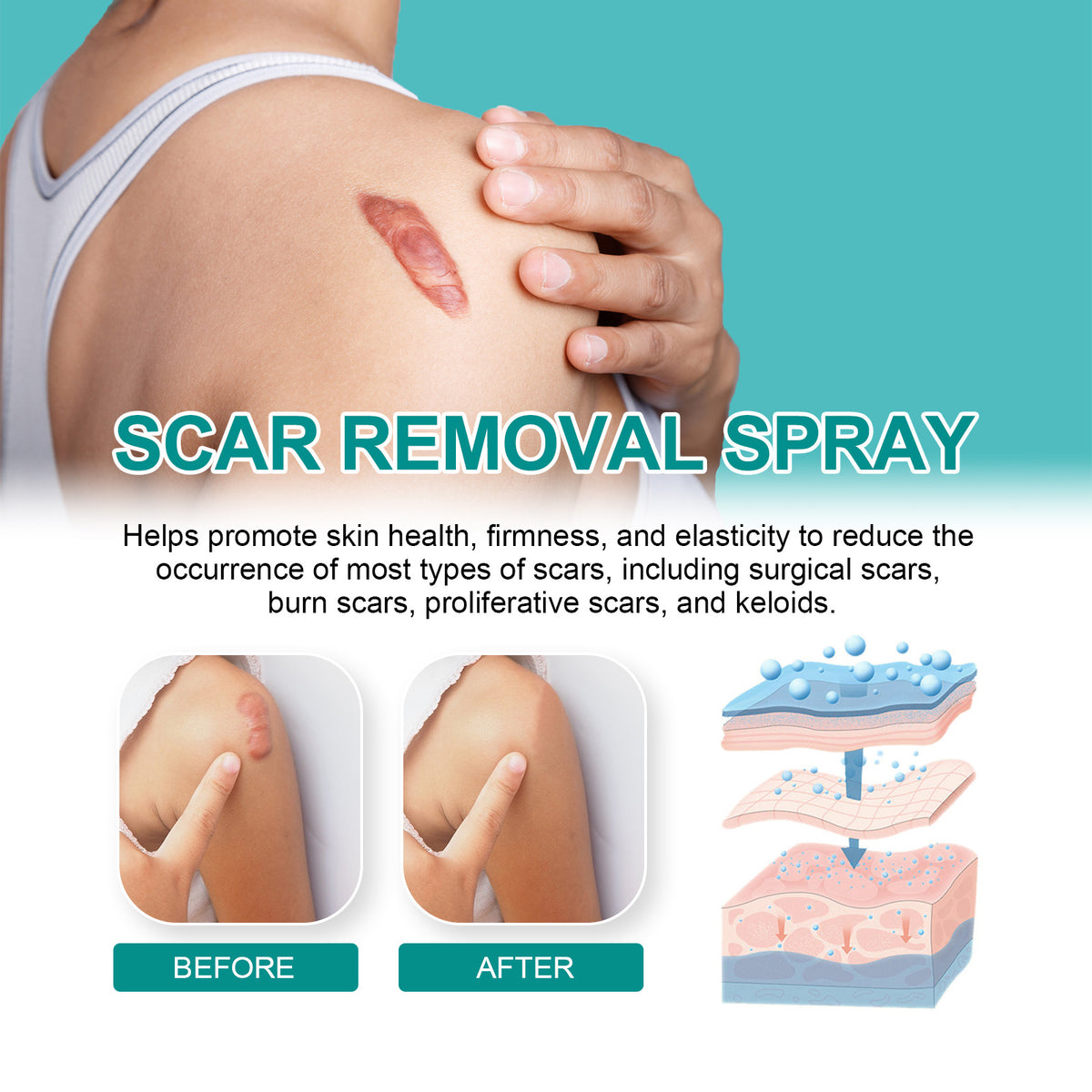 SCAR REMOVAL SPRAY