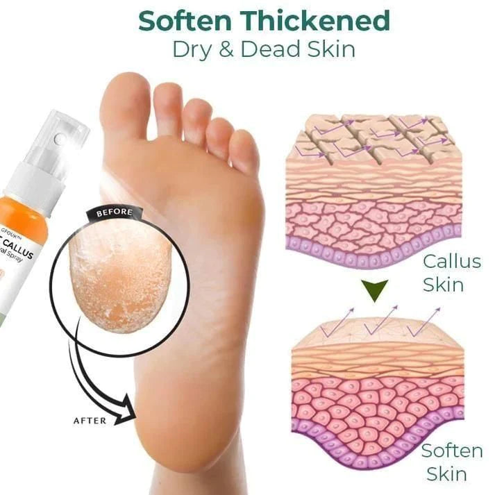 Foot Callus Removal Spray | Buy 1 + Get 1 Free